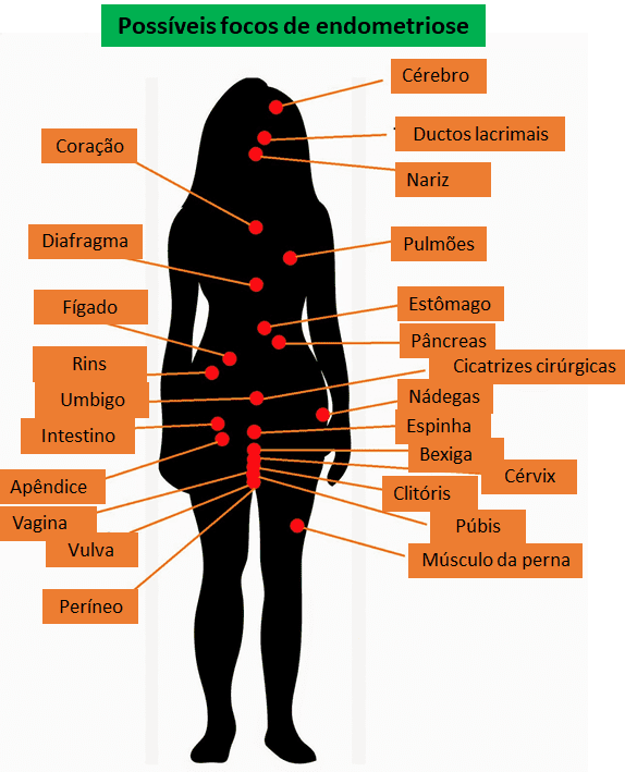 Endometriose possíveis focos da doença e sintomas.